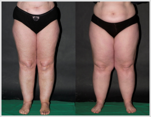 Specialized Liposuction Is Shown to Prevent Lipedema Progression