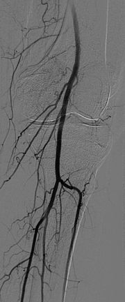 angiogram