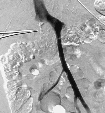 venogram