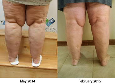 Legs-Rear compare