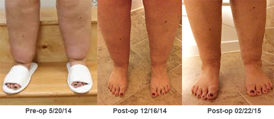 pre-post 12-2014 02-2015